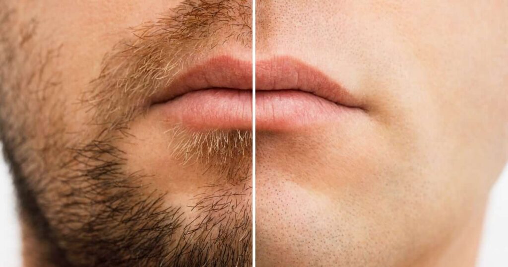 Depilación de la barba. Antes y después.