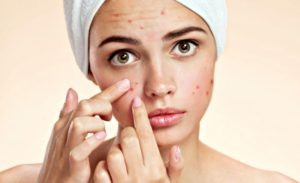 Consejos para evitar el acné