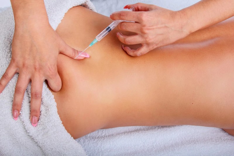 Mesoterapia: una solución estética 