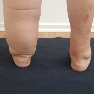 Linfedema.png